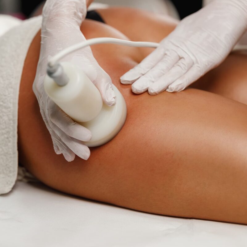 Épilation laser : Quels sont les critères pour savoir si votre peau est adaptée ? Mutzig 1