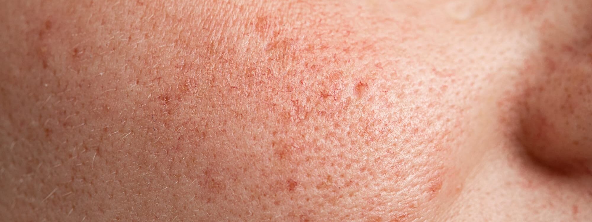 Laser pigmentaire et vasculaire Molsheim
