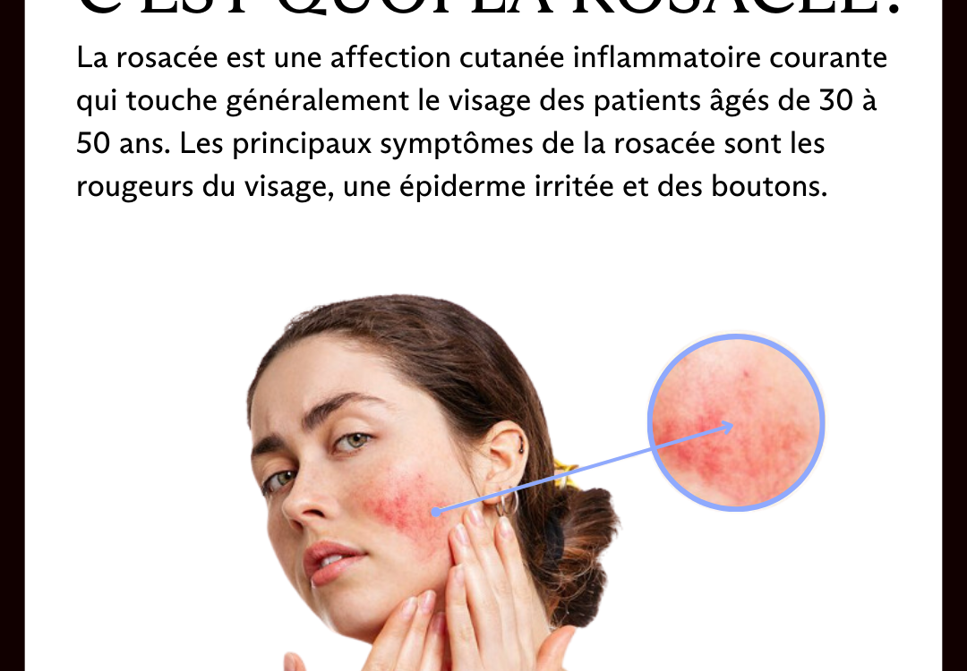 Couperose et l&eacute;sions vasculaires du visage : une prise en charge efficace gr&acirc;ce &agrave; l&rsquo;IPL Stellar Erstein