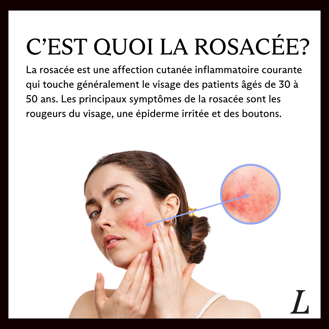 Couperose et l&eacute;sions vasculaires du visage : une prise en charge efficace gr&acirc;ce &agrave; l&rsquo;IPL Stellar Erstein